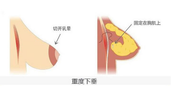 丰胸产品评价_有没有丰胸外用产品？_丰胸外用产品试用装