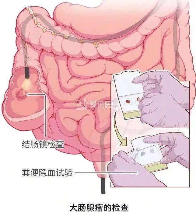 肠镜活检病理报告，都在说的啥？