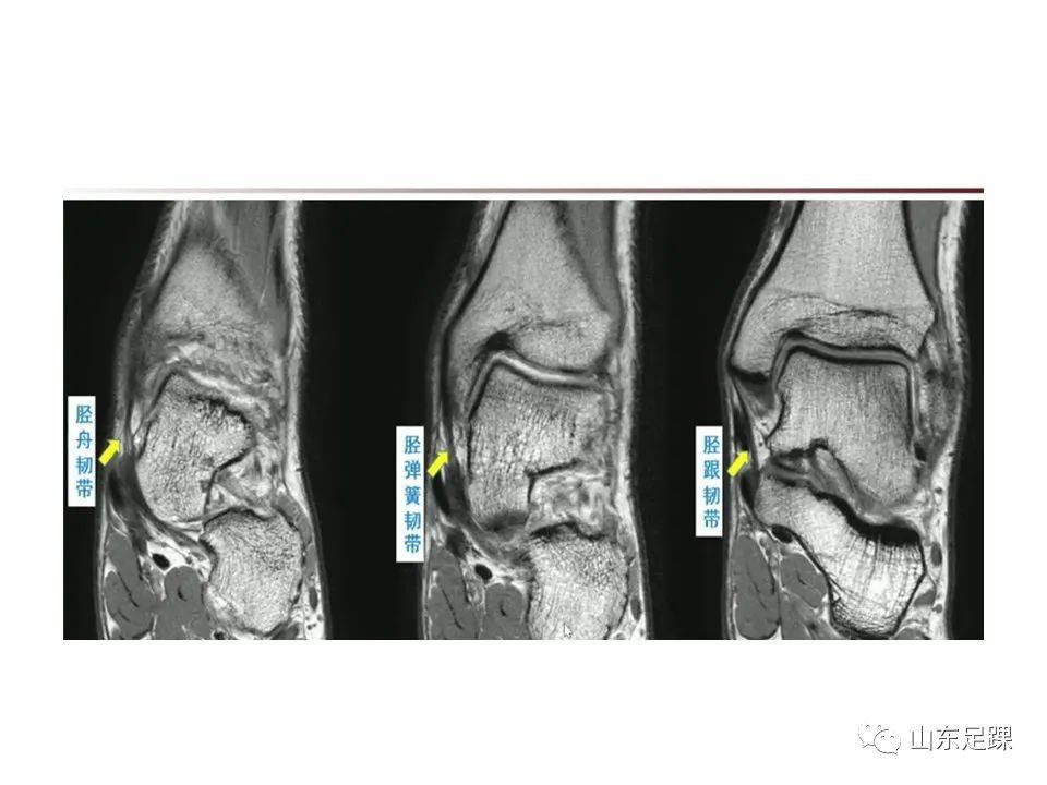 一文了解 | 踝关节影像学检查
