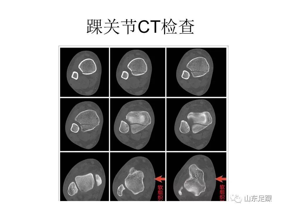 一文了解 | 踝关节影像学检查