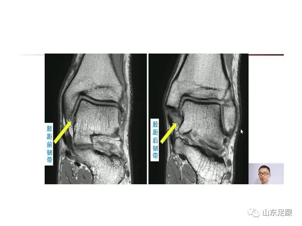 一文了解 | 踝关节影像学检查
