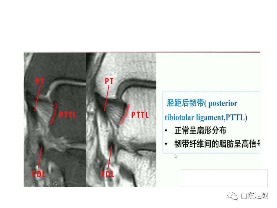 一文了解 | 踝关节影像学检查