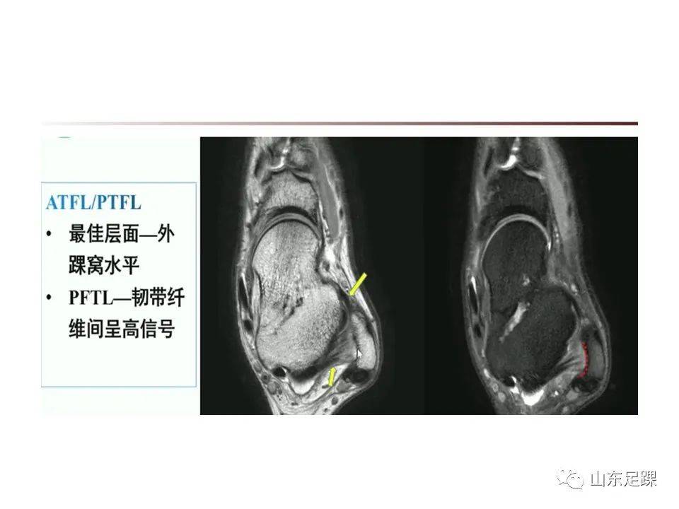 一文了解 | 踝关节影像学检查