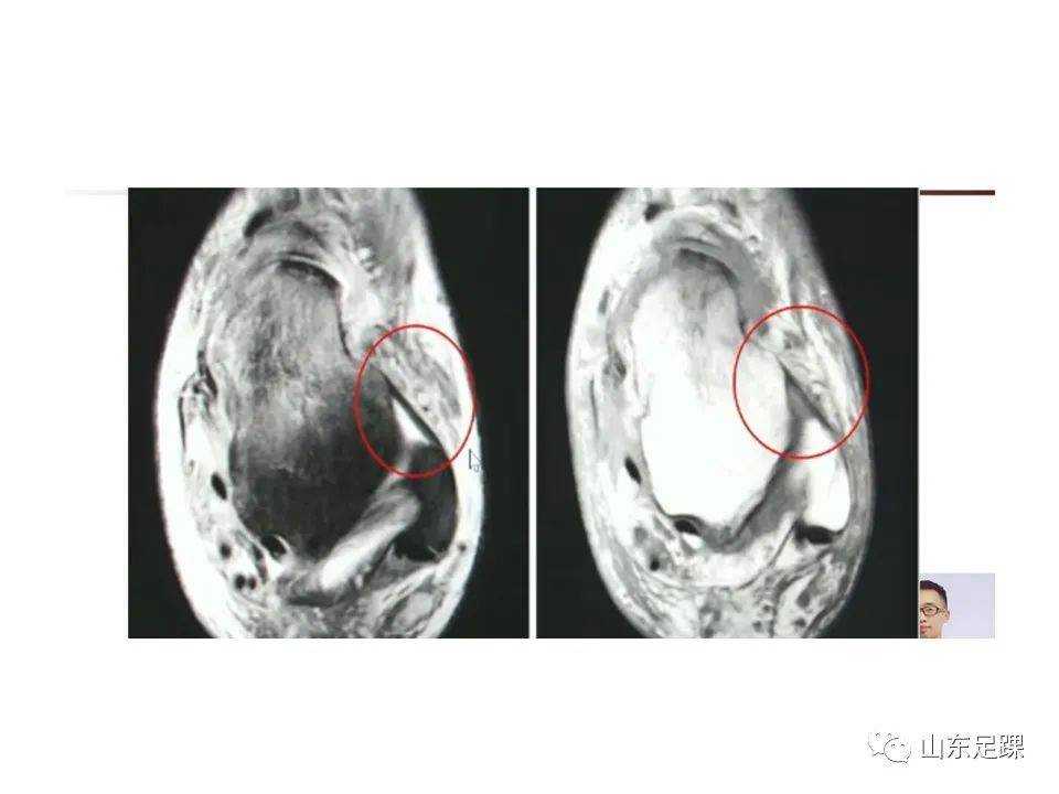 一文了解 | 踝关节影像学检查