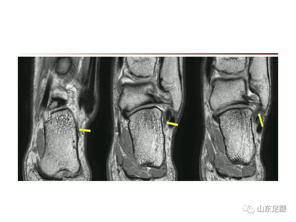 一文了解 | 踝关节影像学检查