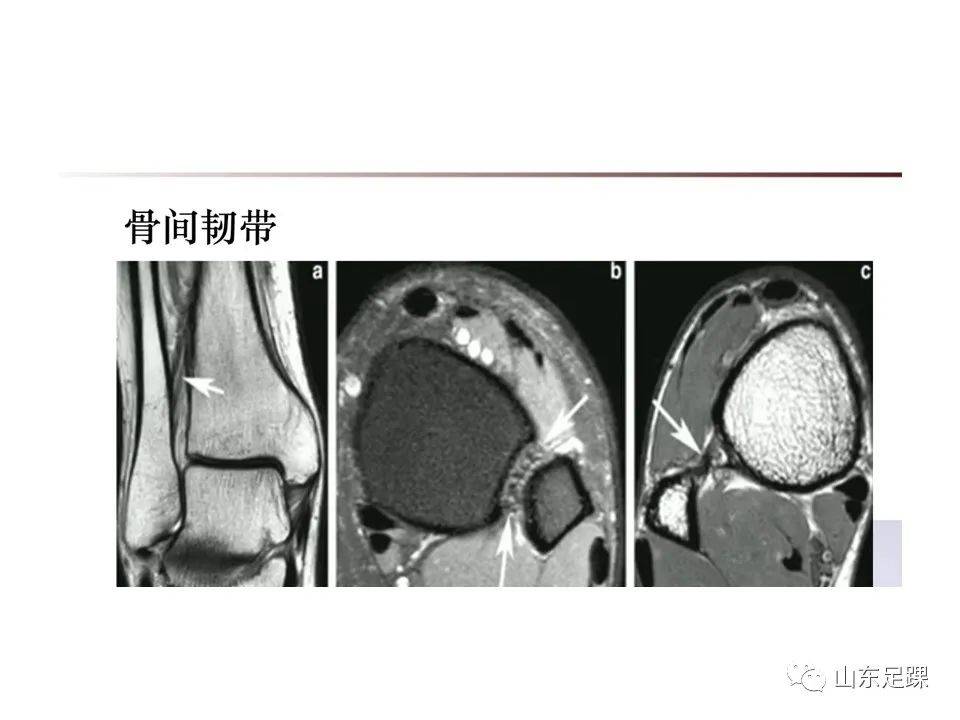 一文了解 | 踝关节影像学检查