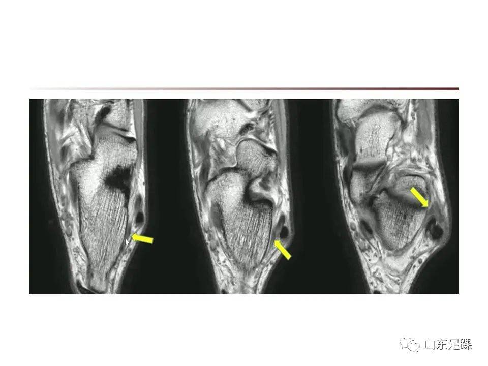 一文了解 | 踝关节影像学检查