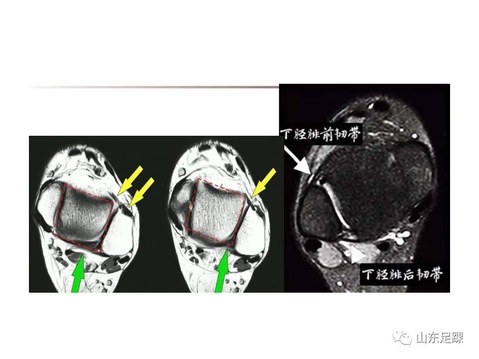 一文了解 | 踝关节影像学检查