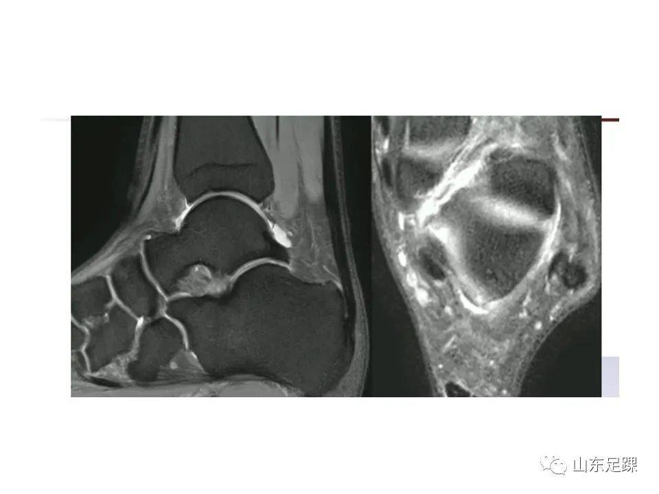 一文了解 | 踝关节影像学检查