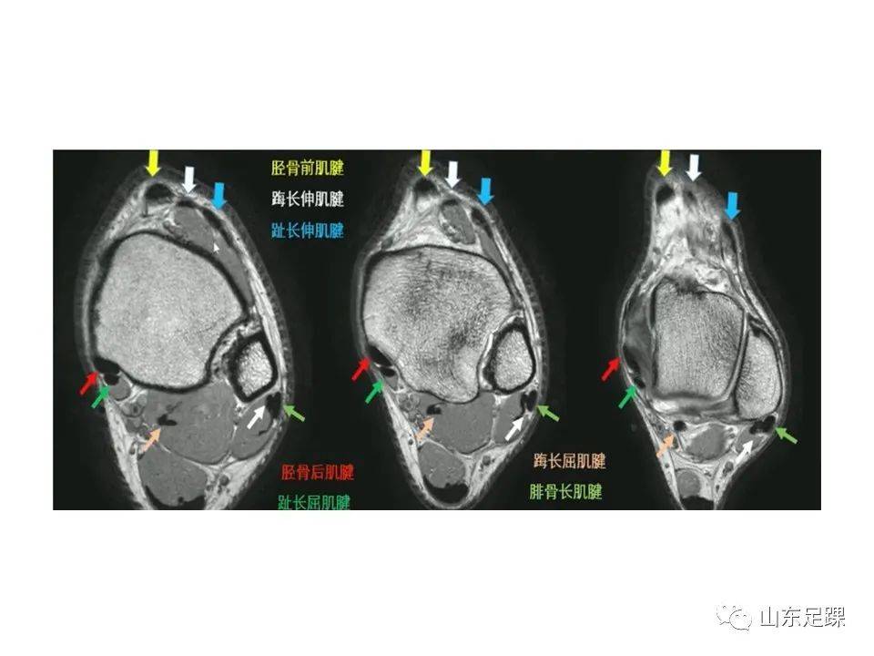 一文了解 | 踝关节影像学检查