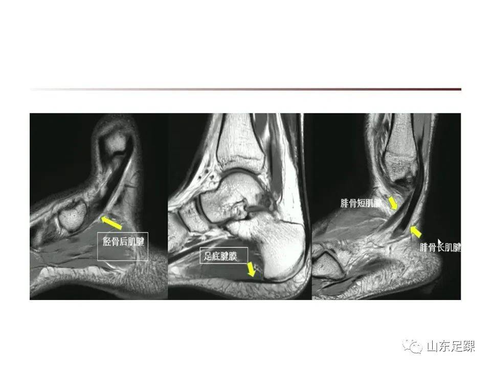 一文了解 | 踝关节影像学检查