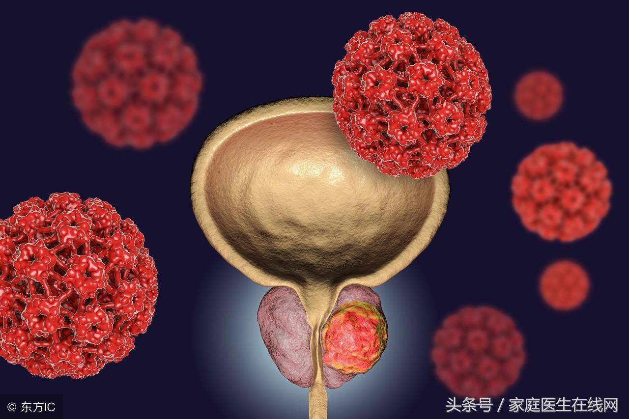 前列腺炎有什么症状_前列腺钙化灶是怎么回事_前列腺