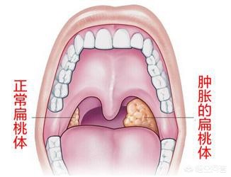 日常，出现3种表现，十有八九咽喉已“发炎”，具体指什么 近期嗓子疼或是此症