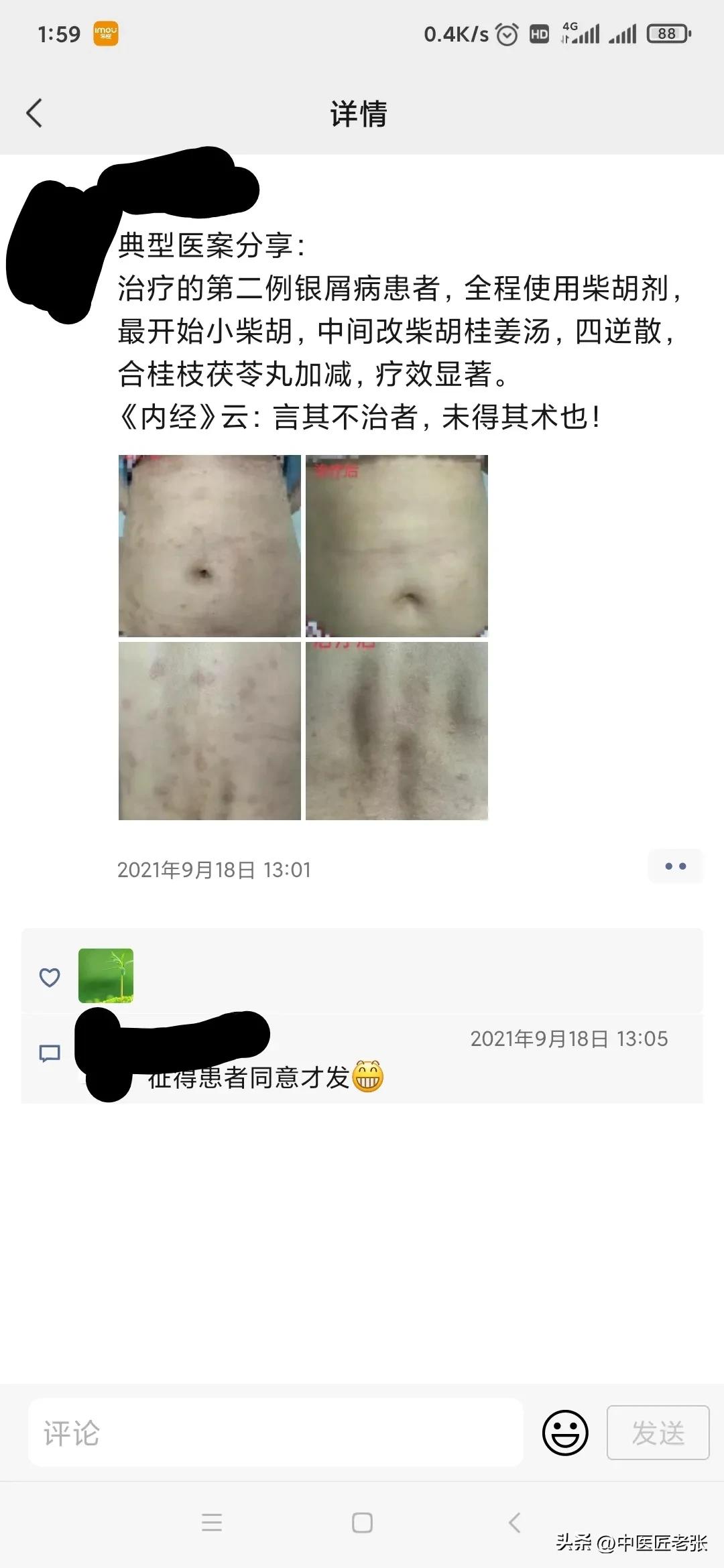 皮损是什么意思 白癜风患者该如何护理皮损处呢