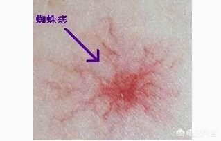 蜘蛛痣图片 皮肤黑，怎么鉴别是不是蜘蛛痣？