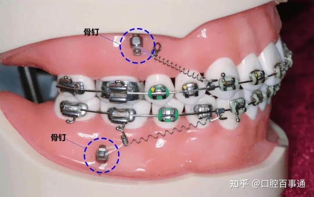 广州牙齿矫正有推荐嘛？