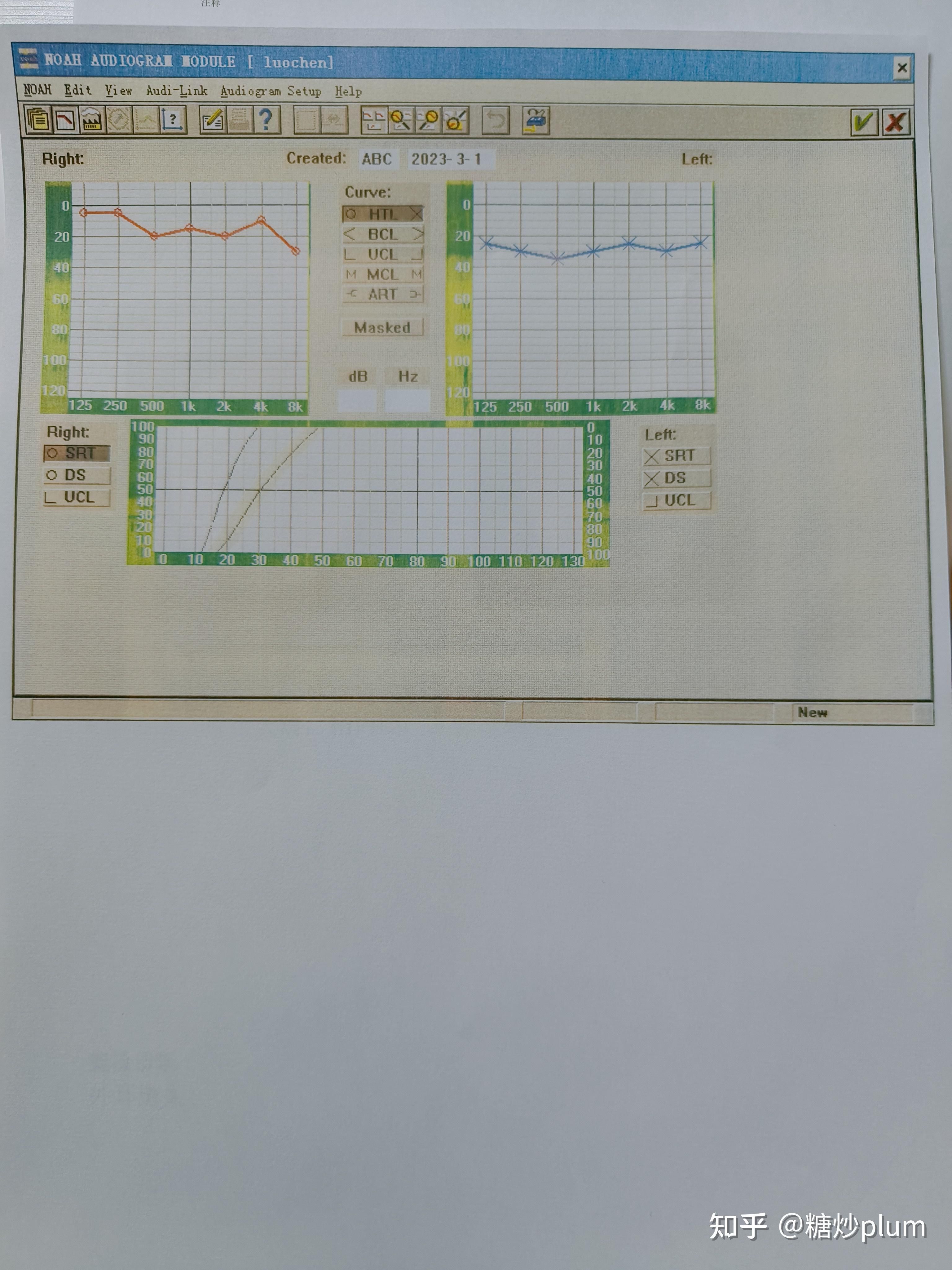 突发性耳聋可以治愈吗？