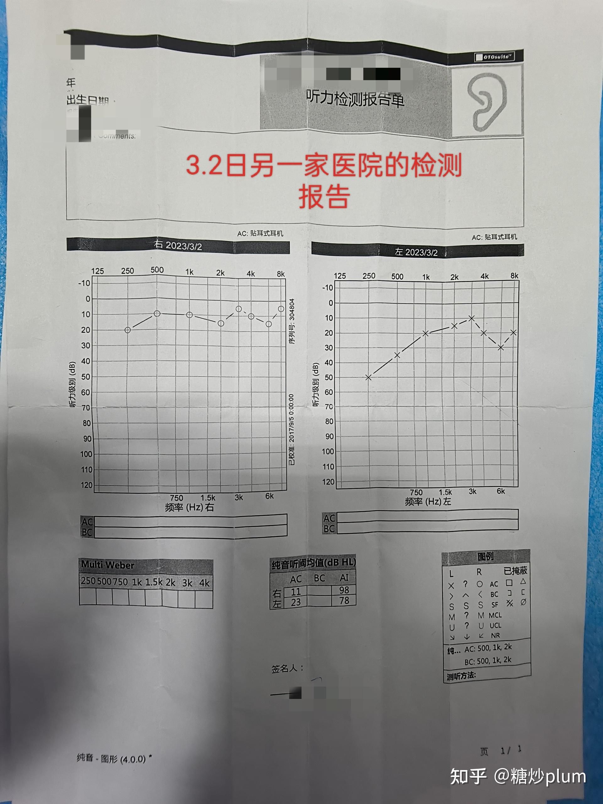 突发性耳聋可以治愈吗？