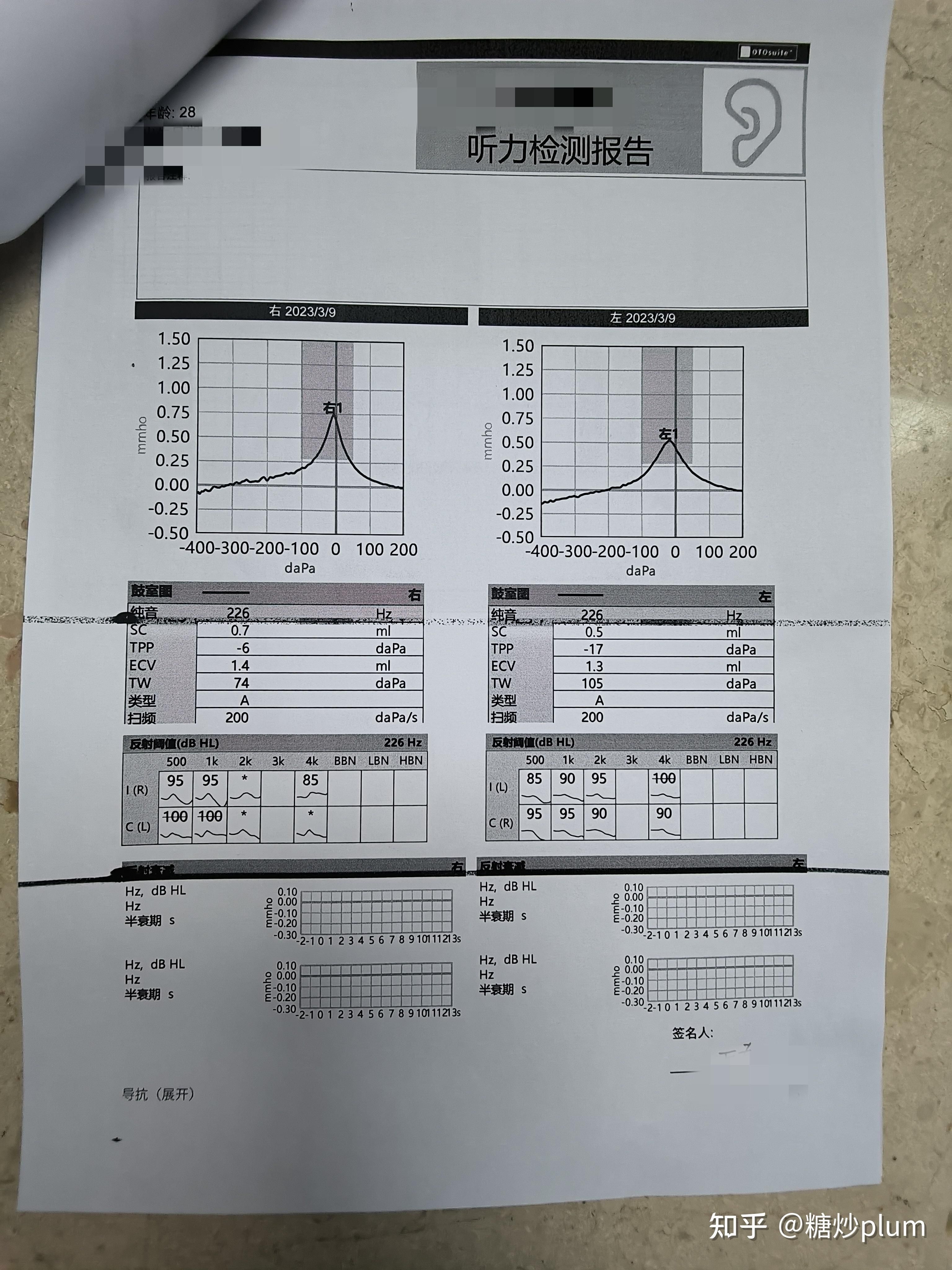 突发性耳聋可以治愈吗？