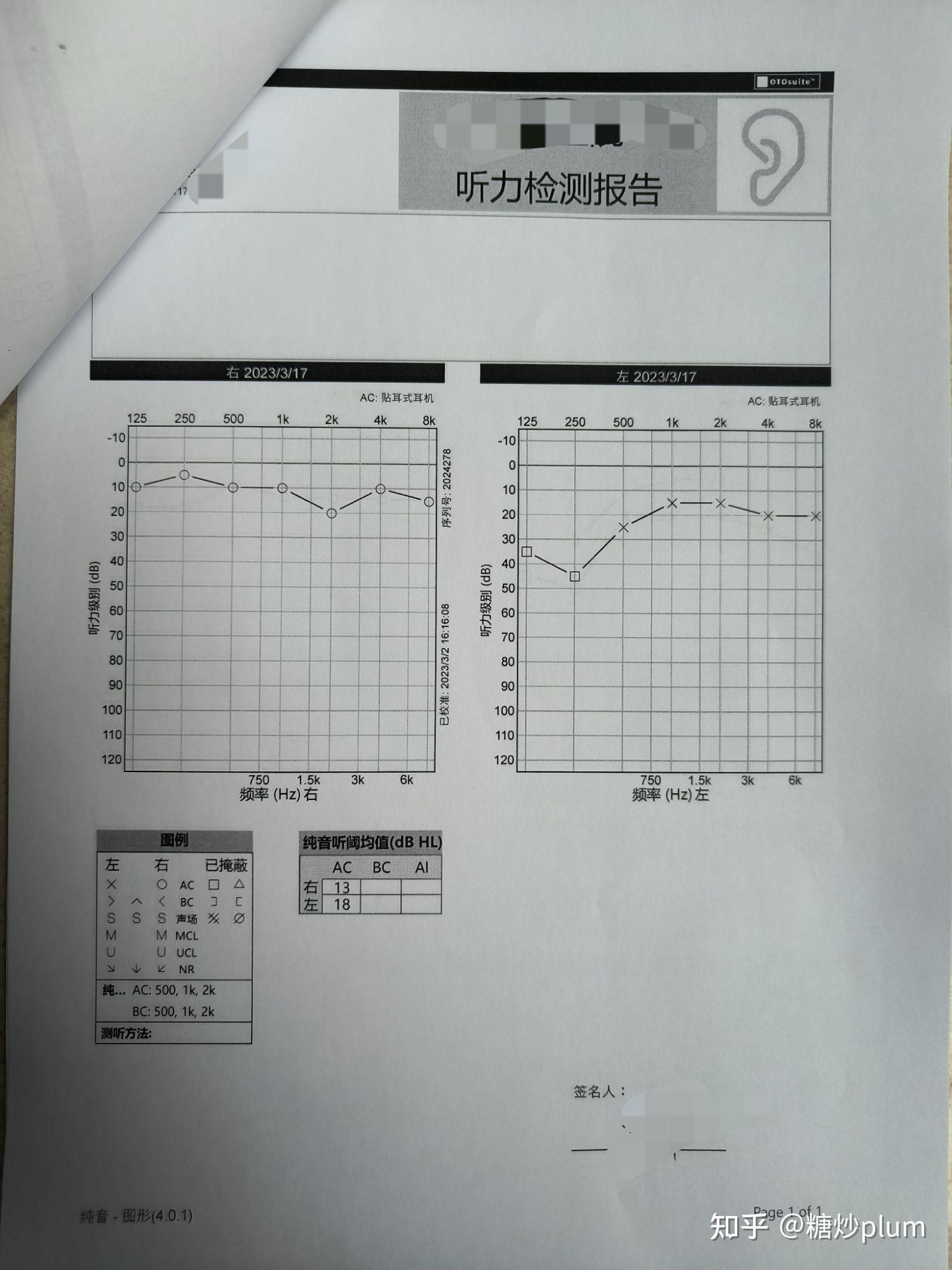 突发性耳聋可以治愈吗？