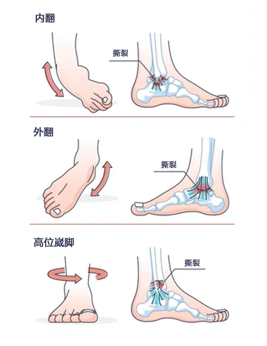 脚踝扭伤一年多现在走路脚踝处很酸疼该怎么办？