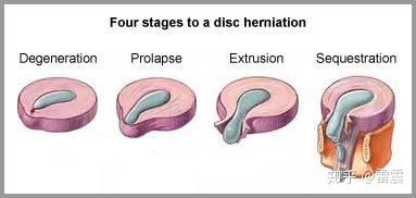 为什么腰椎间盘突出一定要锻炼才能根治？