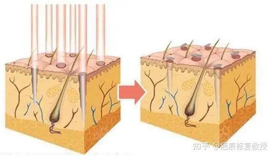 疤痕修复哪家医院好_疤痕修复_疤痕修复最佳时间