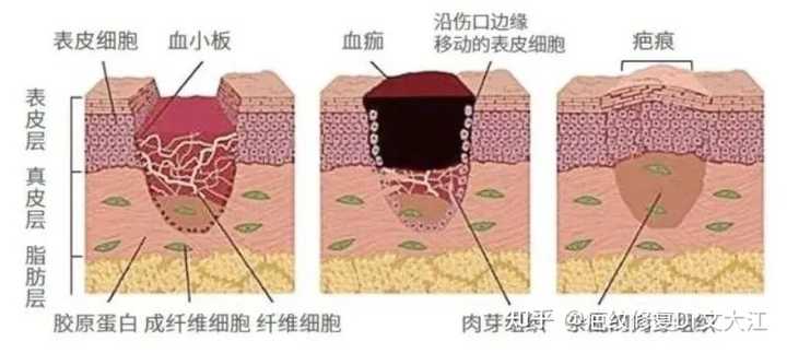 疤痕是如何一步步形成的?