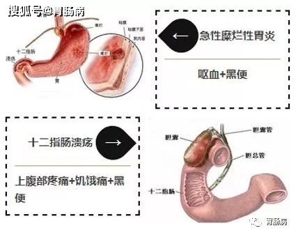 血便图片_血便_血便和便血的区别图片