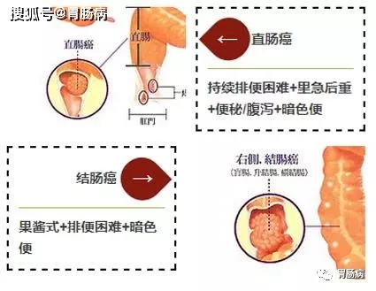 血便和便血的区别图片_血便_血便图片