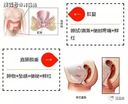 血便_血便和便血的区别图片_血便图片