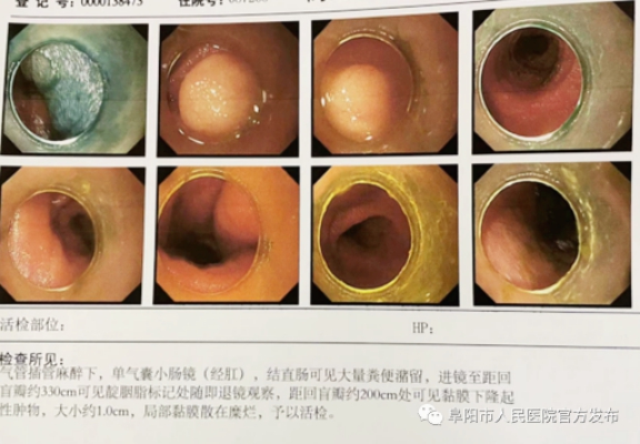 血便_血便怎么回事_血便和便血的区别图片